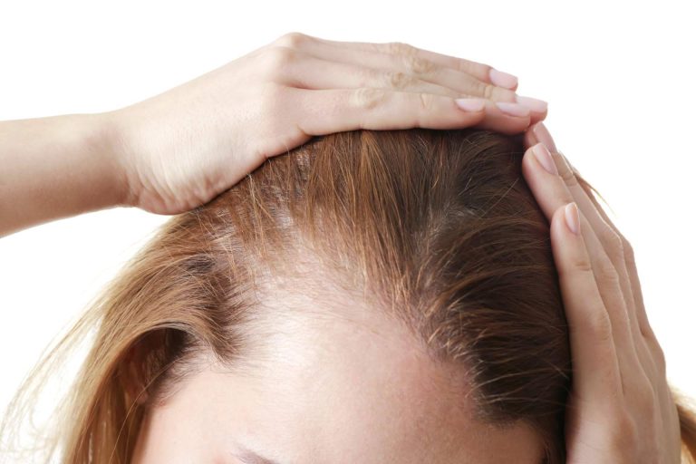 Tratar la alopecia femenina con mesoterapia capilar