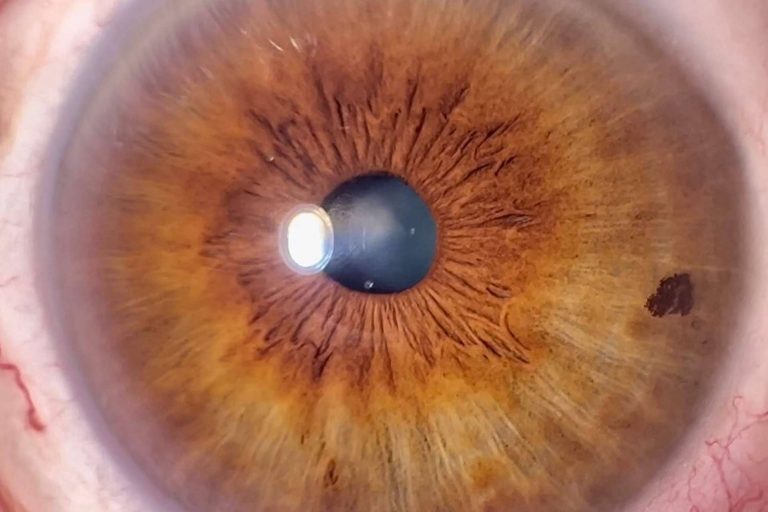 Tomar fotos del iris HD con un smartphone es posible con la técnica de Clínica Eyecos