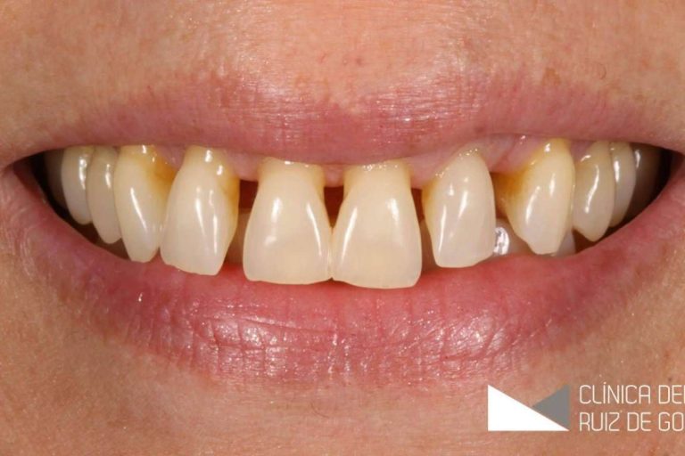 La innovadora técnica de injerto de encías permite restaurar la salud y estética dental con precisión