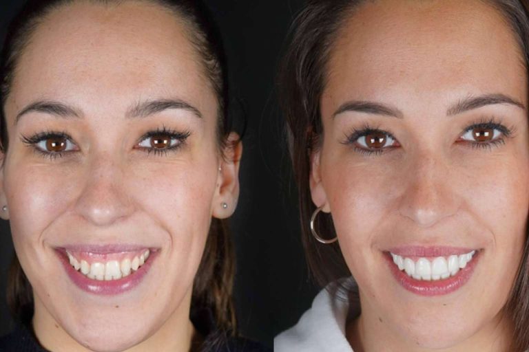 Denty Dent mejora la sonrisa de sus pacientes con tratamientos de estética dental