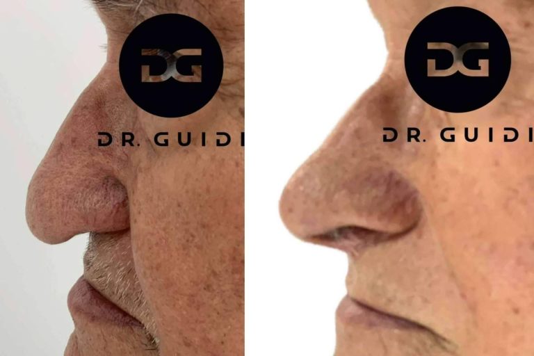 El Dr. Guidi ofrece tratamientos de rinomodelación en su clínica