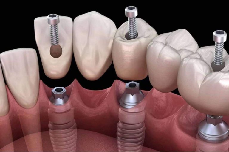 ¿Dónde encontrar un servicio de colocación de implantes? Dental Implantologie