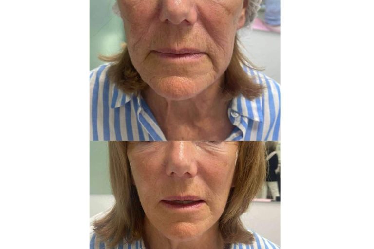 ¿Dónde realizarse los hilos tensores en Málaga?, por Dr. Guidi