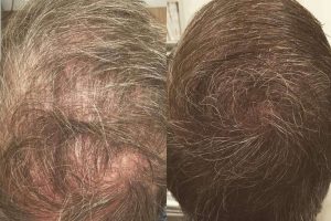 Dermopigmentación Clínica sobre la micropigmentación capilar en mujeres