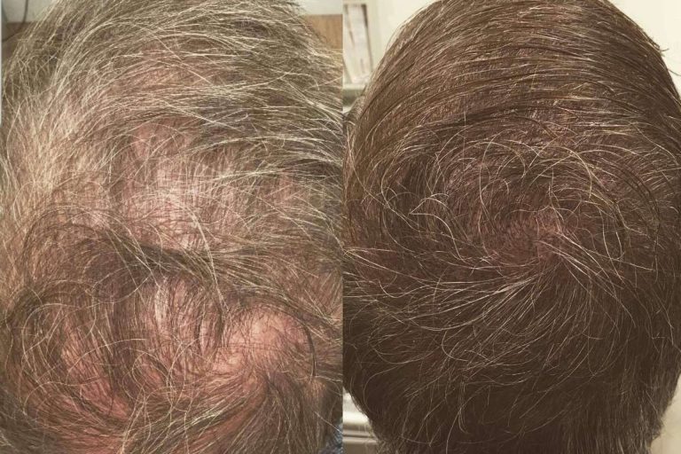 Dermopigmentación Clínica sobre la micropigmentación capilar en mujeres