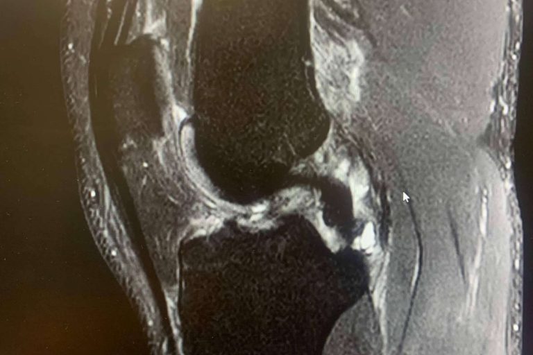 Regeneractiva habla de la prevención de las lesiones de ligamento cruzado anterior