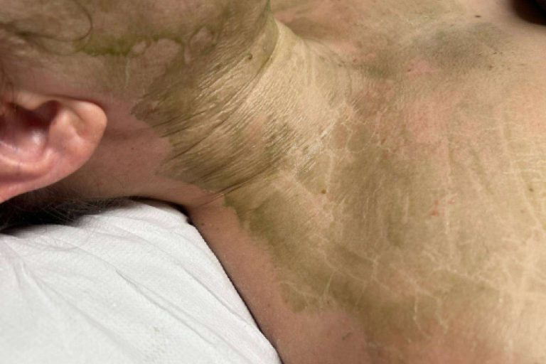 Revolución en los centros de estética con la mascarilla enzimática cosmedique