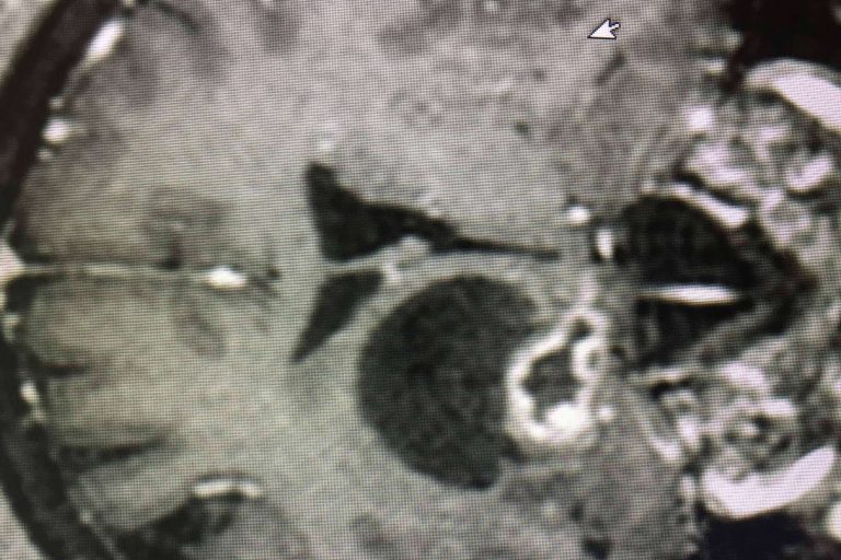 Neurocirugía Galarza aclara en qué consiste la resección tumoral