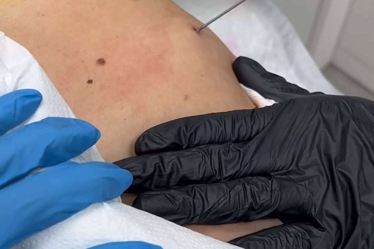 Capilar Innovation Clinic ofrece el tratamiento de endolifting para reducción de grasa corporal y facial