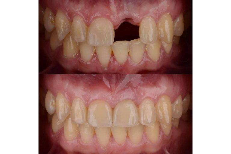 Los beneficios de los implantes dentales, por DeltaDent