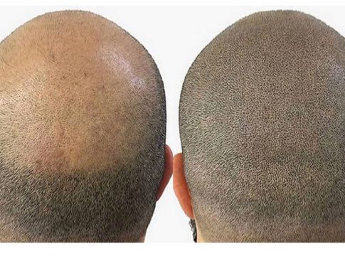 Micropigmentación Capilar