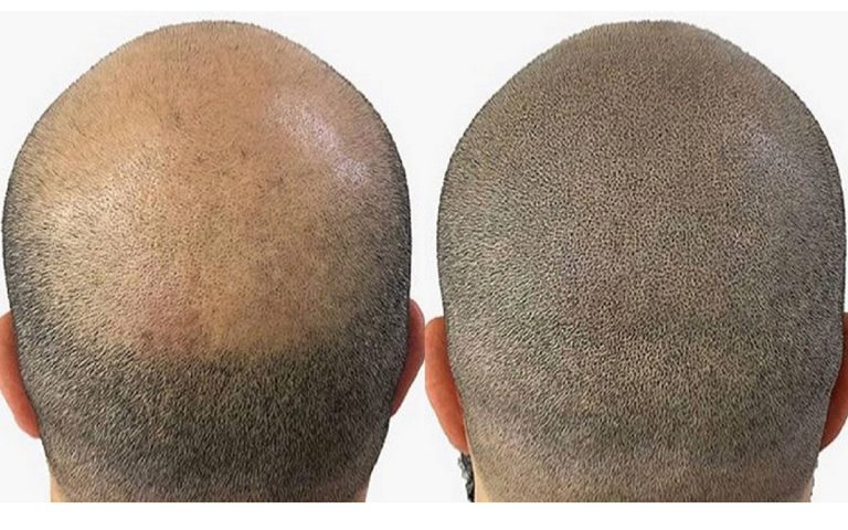 Tattoo School Madrid: Líder en Micropigmentación Capilar y Paramédica en 2024