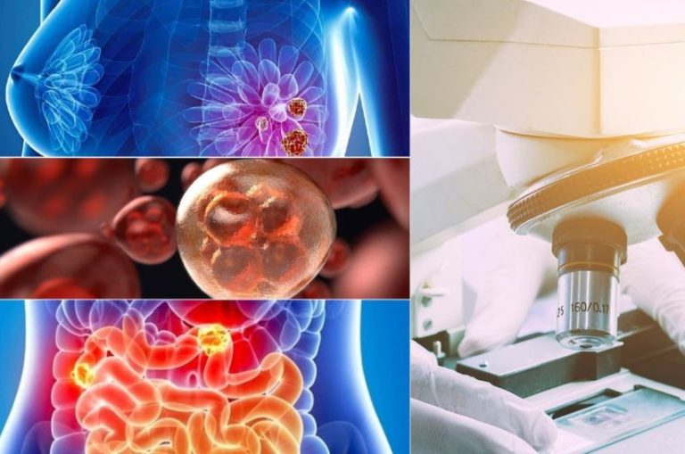 Desigualdad en la atención y barreras en el acceso a tratamientos, retos pendientes para pacientes de cánceres menos conocidos