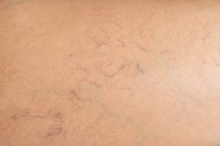 Centro Estético El Pilar, el servicio para quitar arañas vasculares