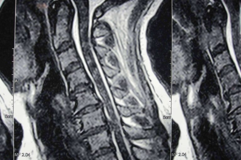¿Qué es la hernia disco cervical?, por Neurocirugía Galarza