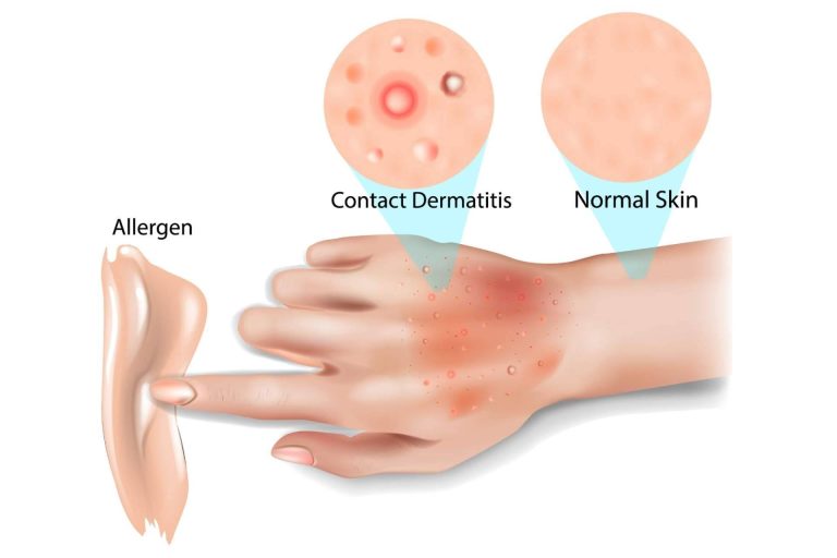 Para la dermatitis, eQuaid Pomada es una solución rápida y eficaz