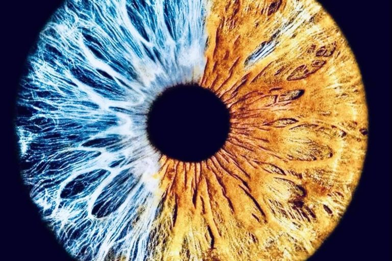 La pigmentación de los ojos se puede clasificar en 5 grados, según Eyecos