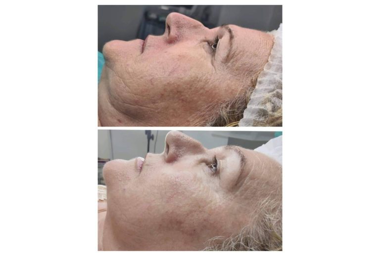 Hidroxiapatita cálcica, el relleno dérmico para un increíble efecto lifting, con los expertos de la Clínica Marta Solà