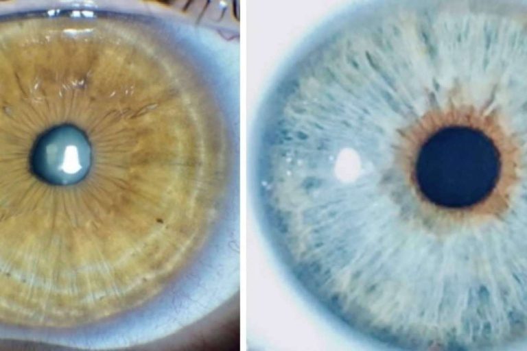 Eyecos, la clínica que puede predecir y simular en 3D el resultado del cambio de color de ojos con láser