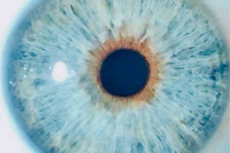 Eyecos explica qué implica cambiarse el color de los ojos con láser, por Eyecos