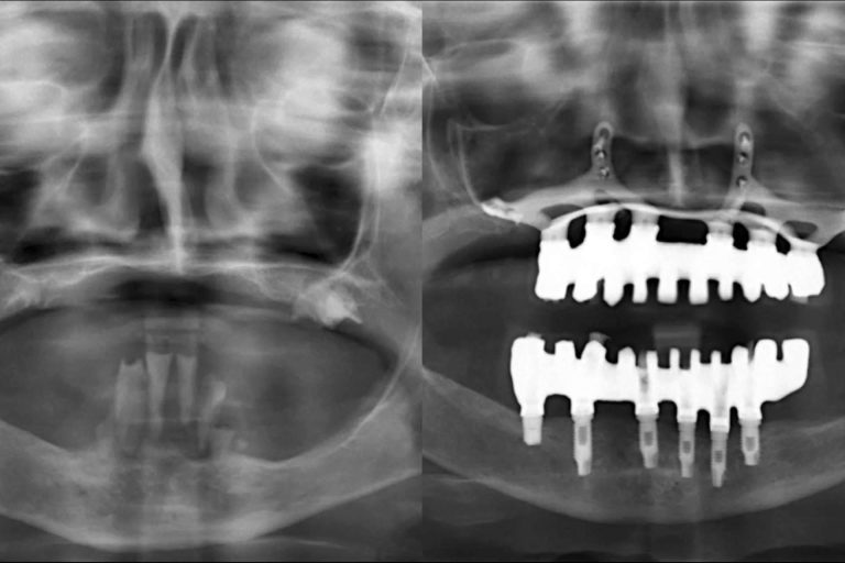 Expertos en implantes dentales, con la Clínica Calvo de Mora en Madrid