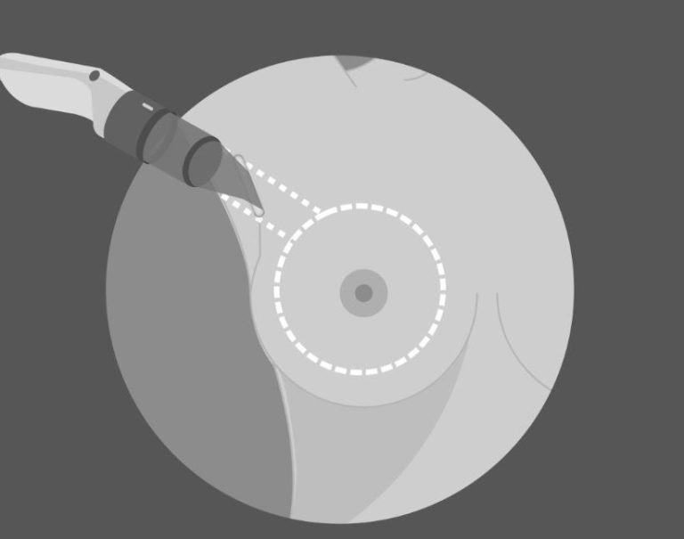 La Clínica Planas, pionera en una nueva técnica para el aumento de pecho con recuperación en 90 minutos