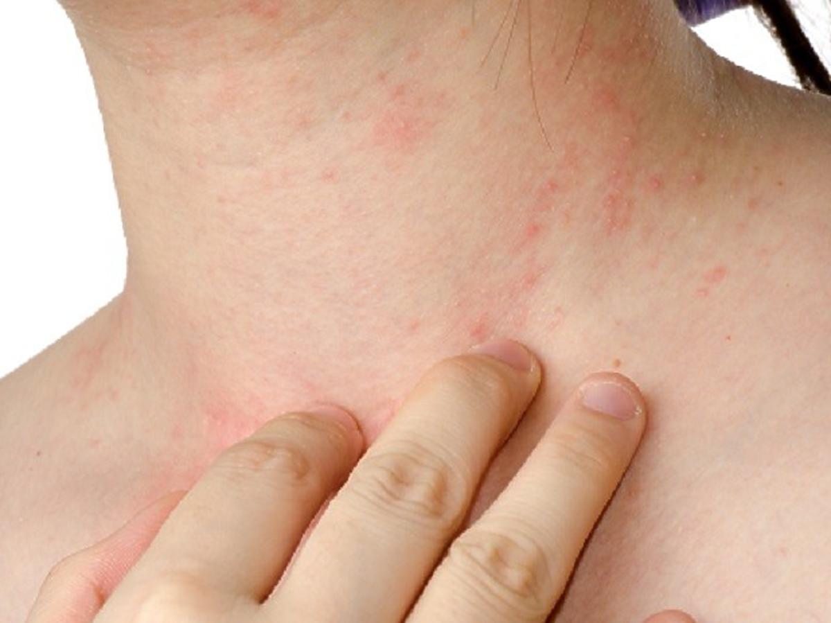 ALIMENTACIÓN Y ALERGIAS