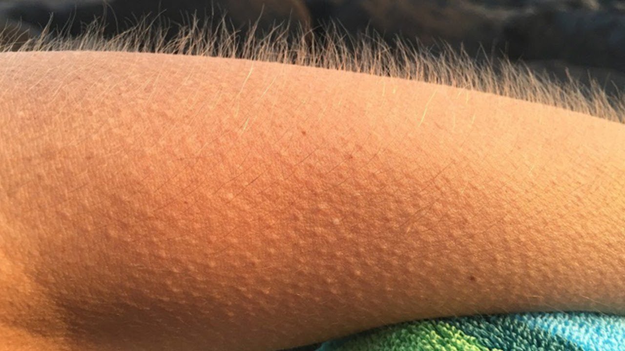 La razón por la que se nos pone la carne de gallina 1 UN ESCALOFRÍO EVOLUTIVO