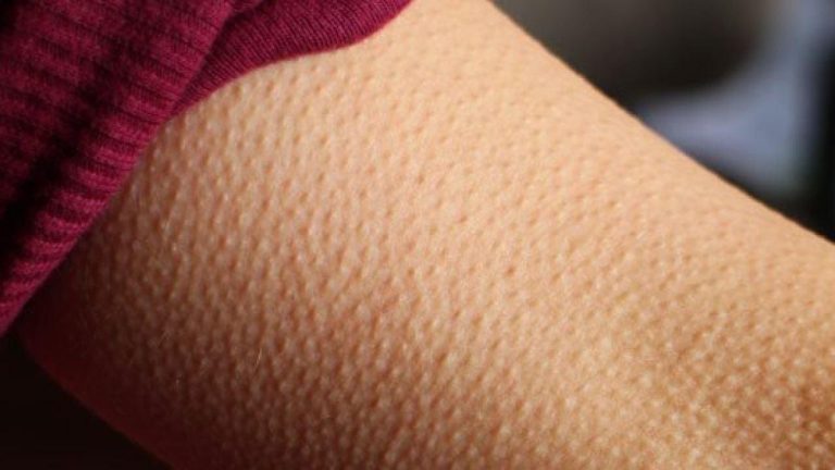 La 'piel de gallina' no es casual: un médico explica por qué aparece con canciones o frío y qué revela de nuestro pasado