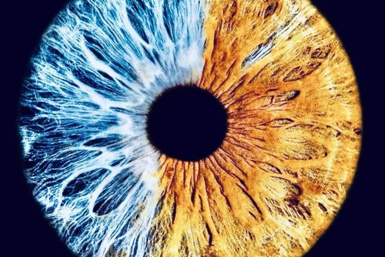 Eyecos habla sobre las heterocromías congénitas