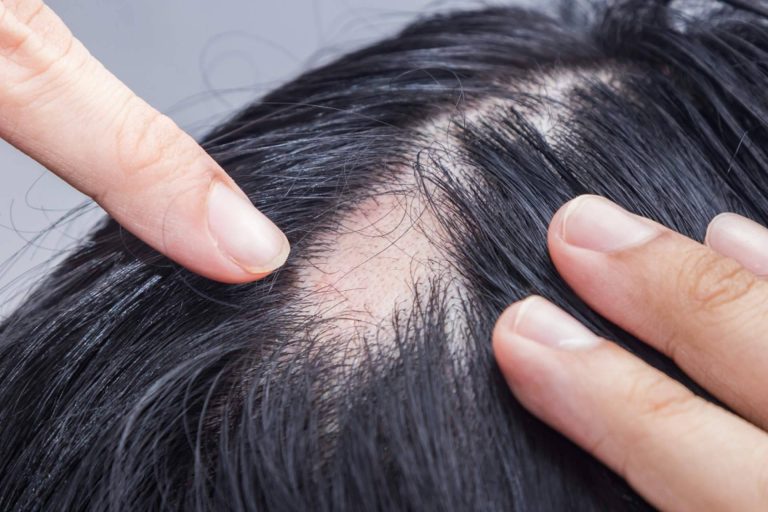 Tratamientos para la alopecia androgénica con Saw Palmetto
