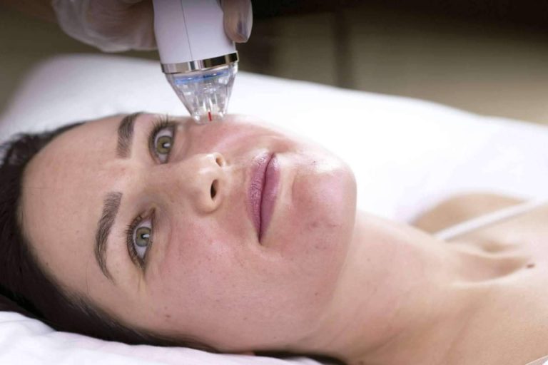 Técnica de resurfacing facial para mejorar la piel del rostro, con Alluring Clinic