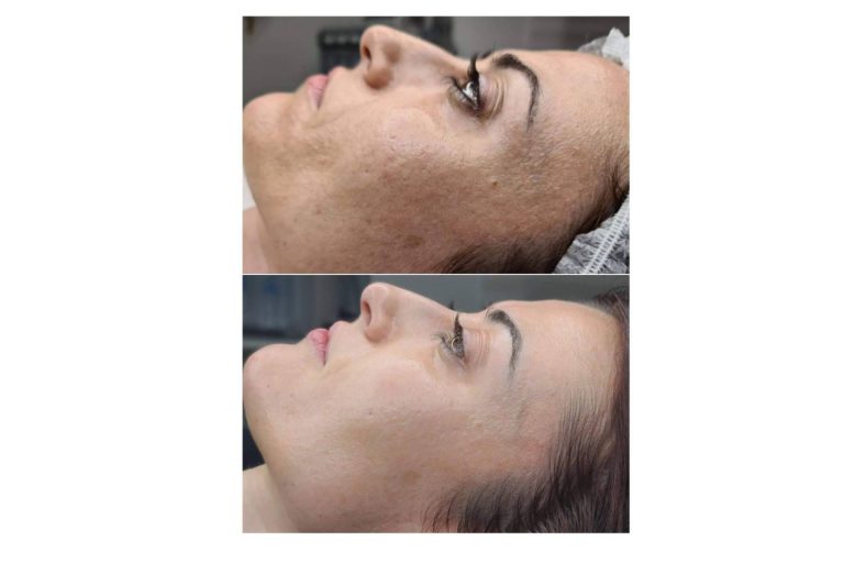 Clinica Marta Solà y la renovación celular con biomicroneedling, la técnica basada en espículas de esponja