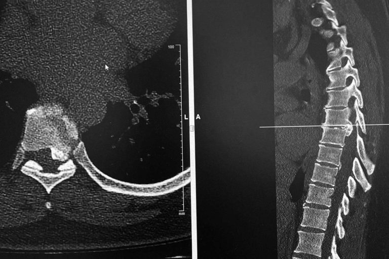 El neurocirujano Dr. Carlos Botella-Asunción es especialista en cirugía de hernia discal