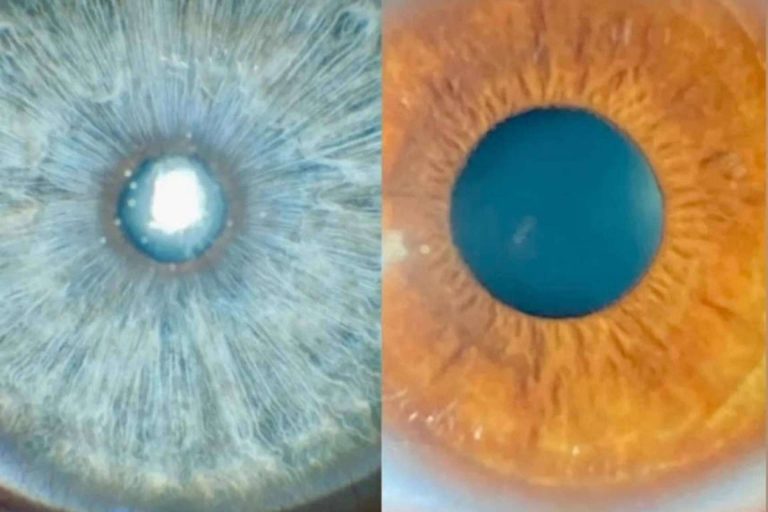 Seleccionar candidatos para cambiar el color de ojos con láser