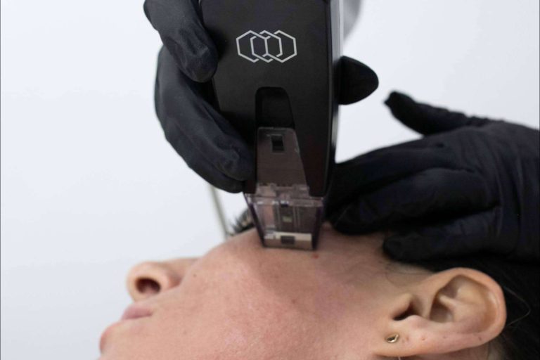 La Clínica BK ofrece un el tratamiento rejuvenecedor Morpheus8 Facial y Corporal