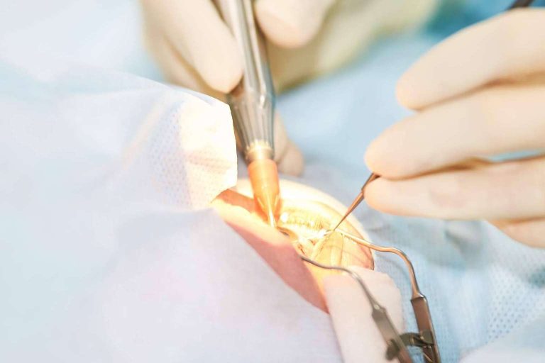 Cirugía refractiva en el Departamento de Oftalmología del Hospital Universitari Dexeus