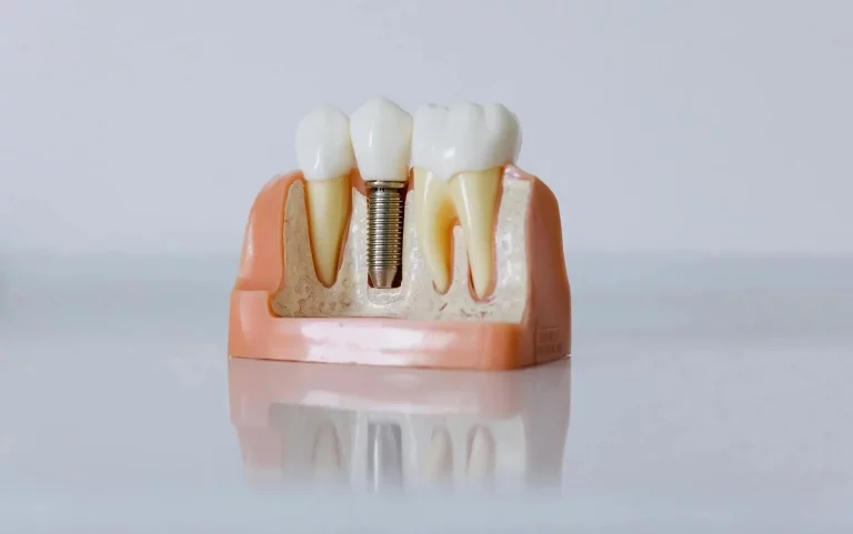¿Qué es un implante dental?
