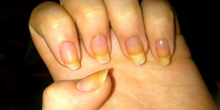 Cómo prevenir las uñas amarillas: Soluciones efectivas a tu alcance