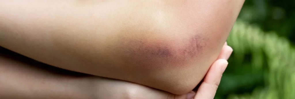 ¿Cómo curar un hematoma de nuestro cuerpo de forma natural?