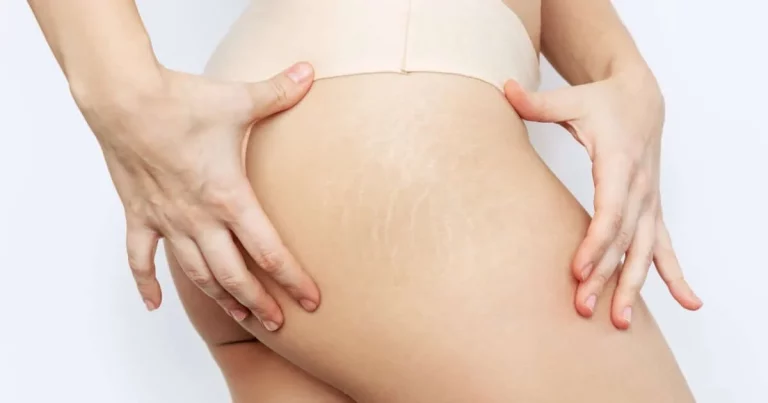 Los 5 remedios caseros para decirle adiós a las estrías de cara al verano