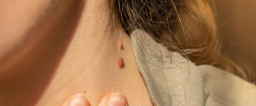 Dile adiós a las verrugas con estos elementos naturales