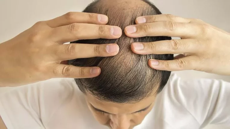 Cómo prevenir la caída del cabello con productos naturales