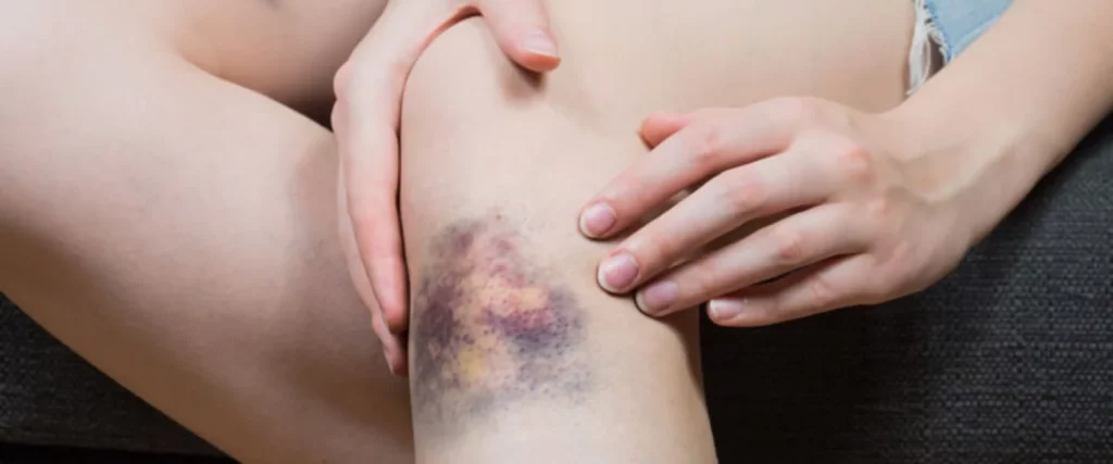 Un plan B para curar un hematoma también con un elemento natural