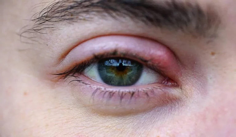 Los remedios más efectivos para curar los orzuelos