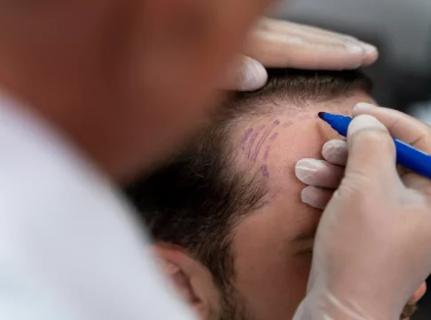 medicos capilares ¿Quieres que te traten los mejores médicos capilares especialistas en injerto capilar en Madrid?