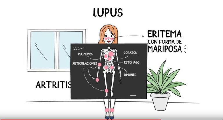 Reumatólogos advierten sobre la importancia de la vacunación en pacientes con lupus