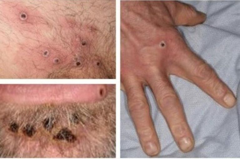 Galicia reforzará la información y las medidas para la detección de la viruela del mono