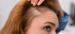 El 76% de los españoles ha tenido caída de pelo en España, pero solo el 30% ha ido al especialista