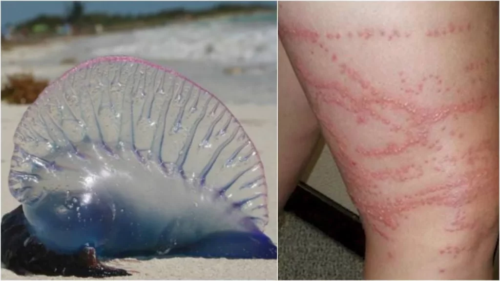 Cómo tratar la picadura de forma eficaz